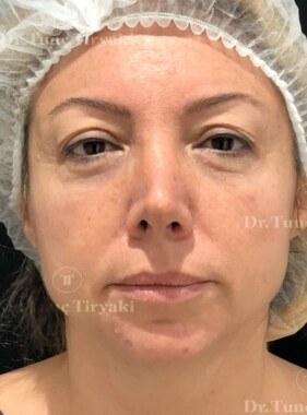 Before Blepharoplasty | Gallery Image 8