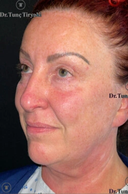 Before Blepharoplasty | Gallery Image 11