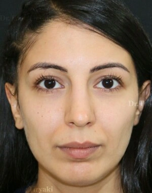 Before Fat Transfer | Gallery Image 4