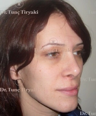 Before Fat Transfer | Gallery Image 2