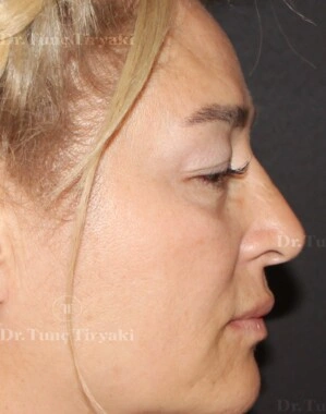 Before Blepharoplasty | Gallery Image 6